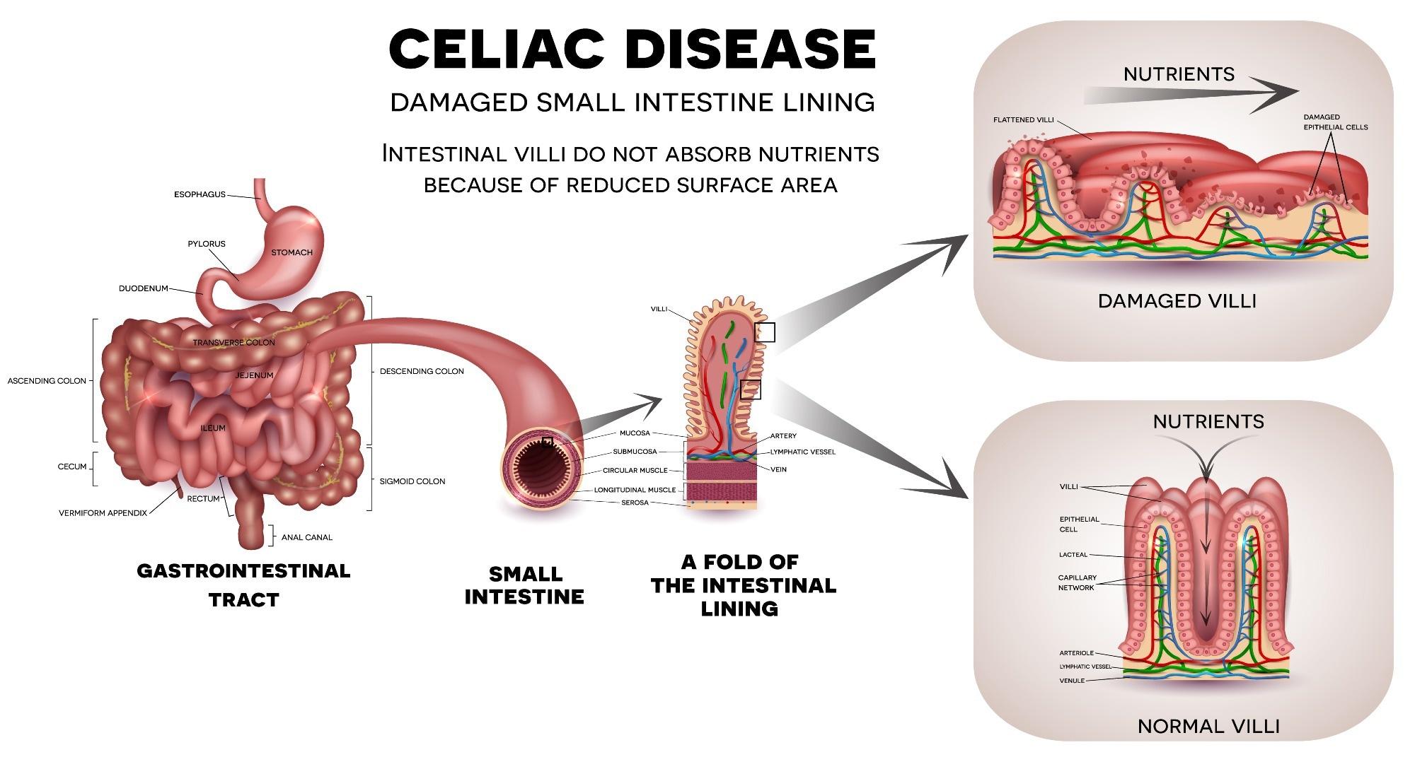 The Science Behind Gluten Sensitivity in Non-Celiac Individuals